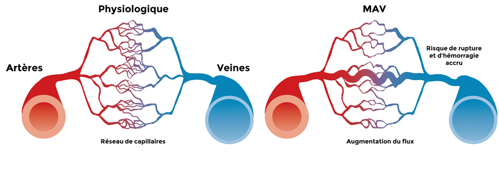 Schéma de la structure d’un réseau de capillaires sain et d’une MAV adapté de Lawton et al. Nature Rev Dis Primers 2015 (3)