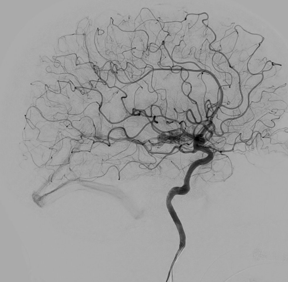 Arteriographie-neuri